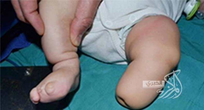  116 طفلا مشوها في الديوانية خلال 2014